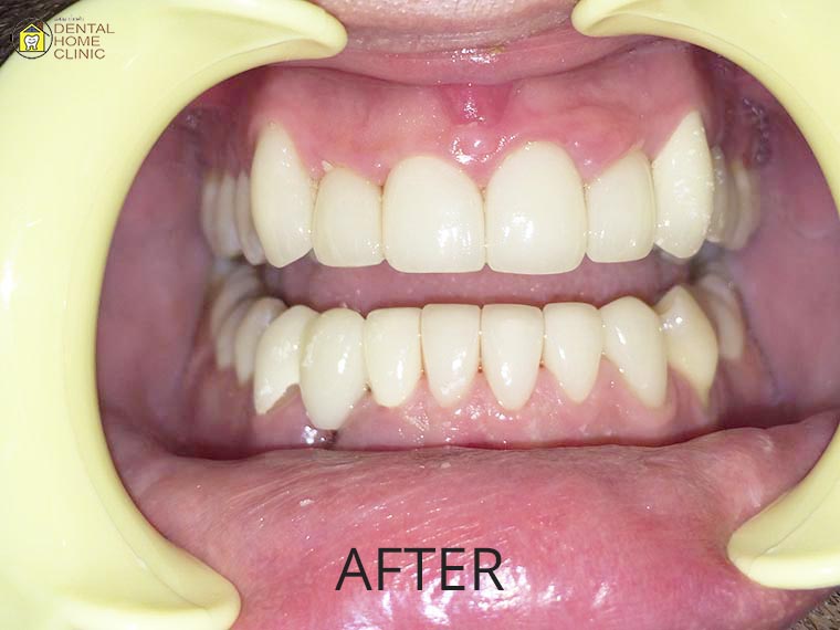 Smile Makeover