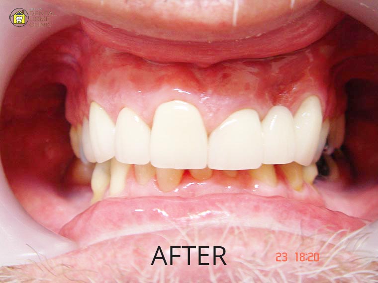 Smile Makeover