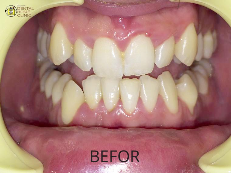 Smile Makeover