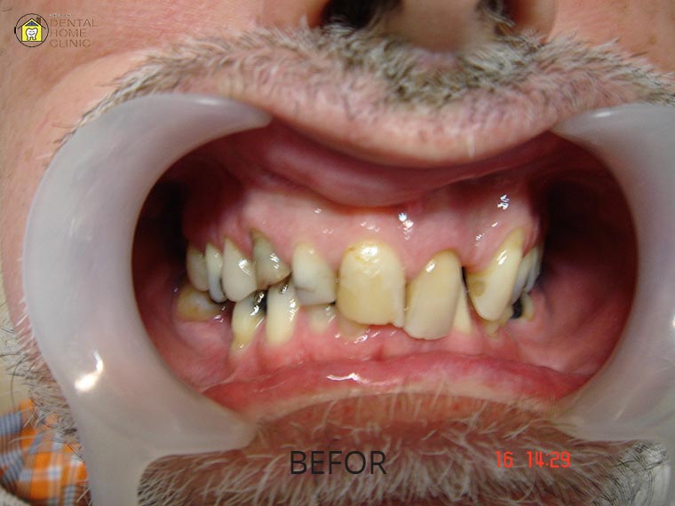 Smile Makeover