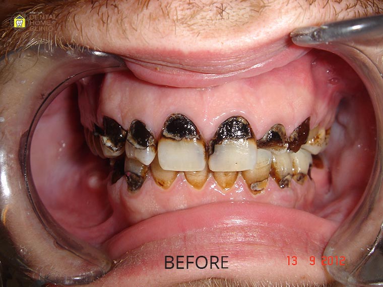 Smile Makeover