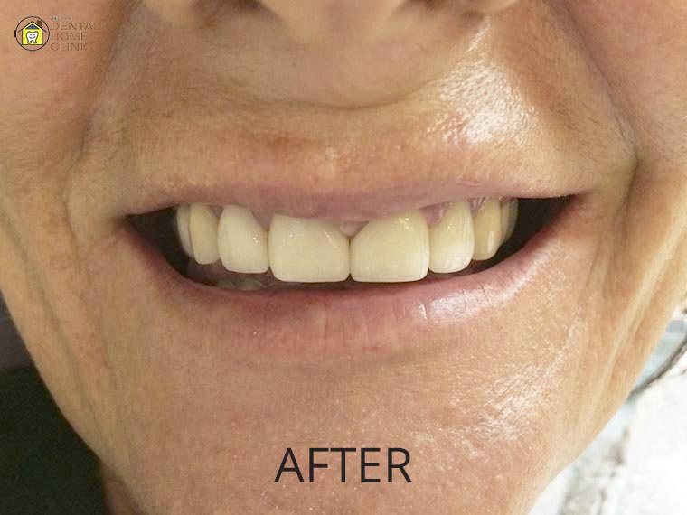 Smile Makeover