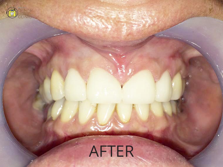 Smile Makeover