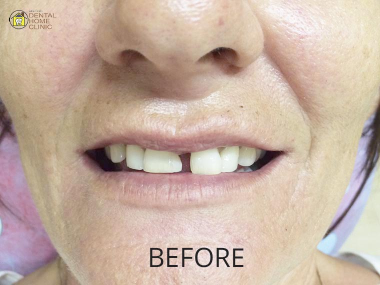 Smile Makeover