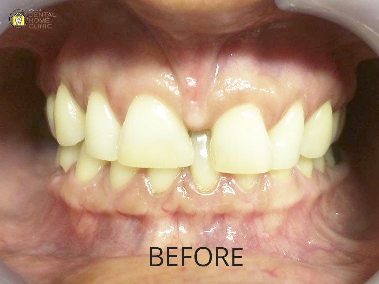 Smile Makeover