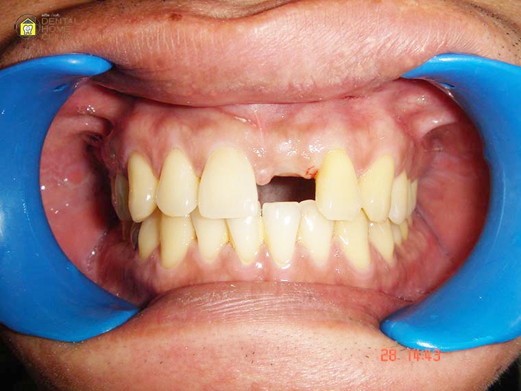 implant1