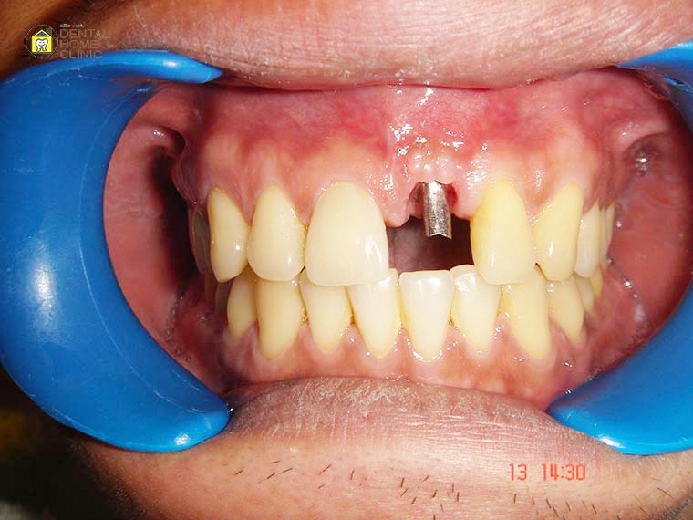 implant2