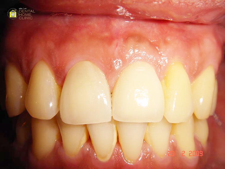 implant3