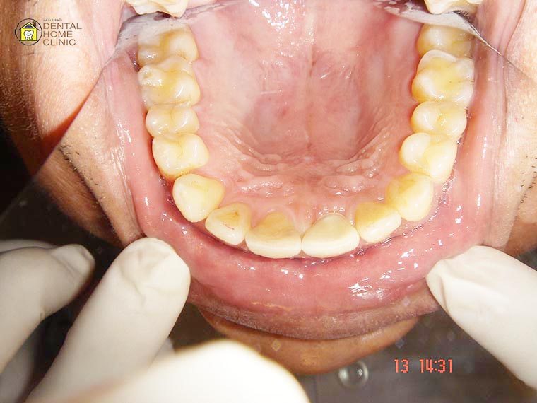 implant4