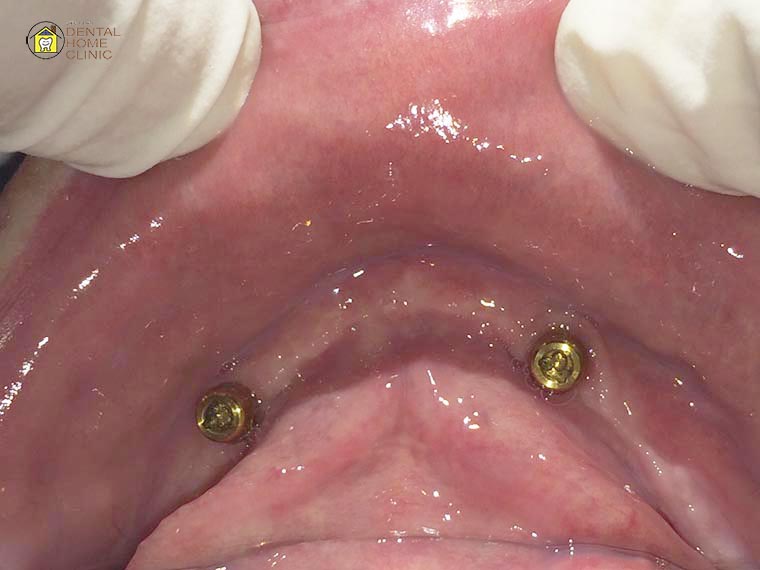 implant5