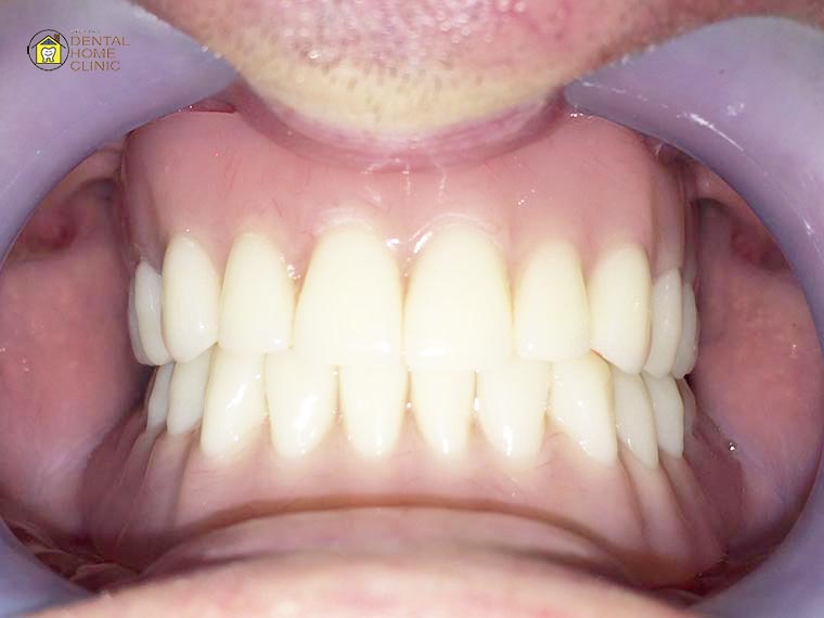 implant7