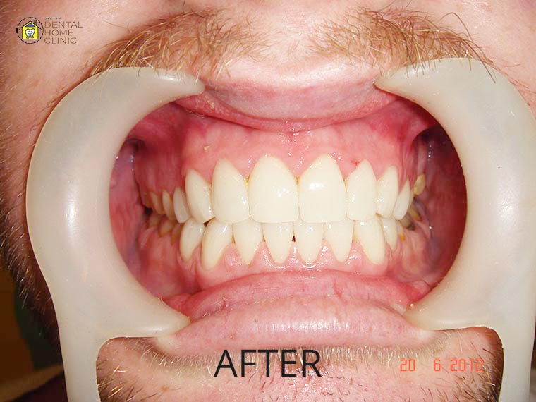 Smile Makeover