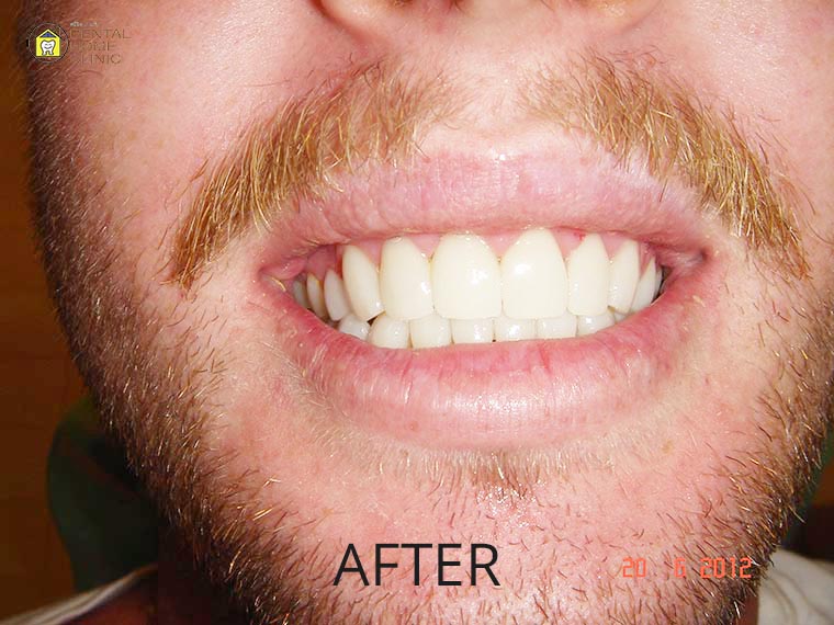 Smile Makeover