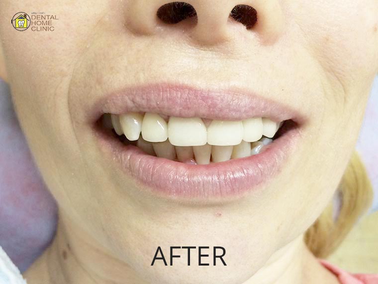 Smile Makeover