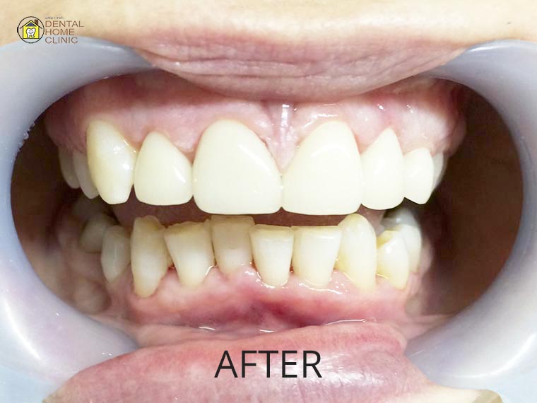 Smile Makeover