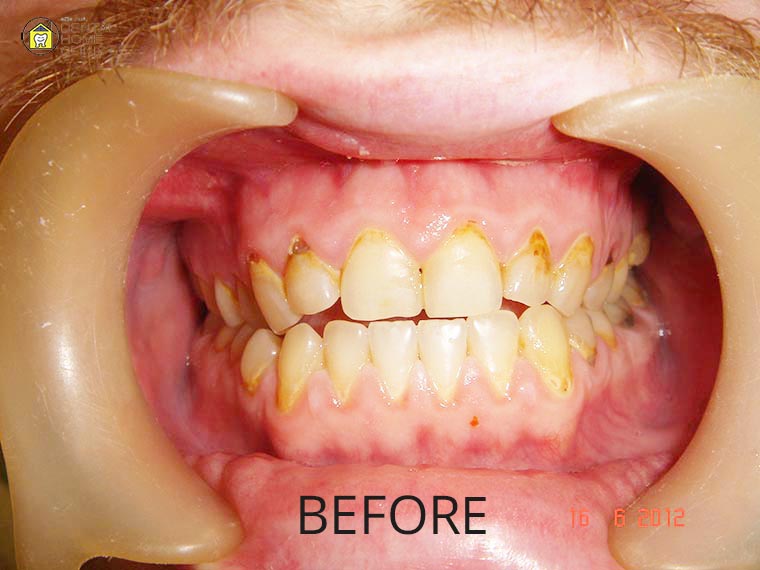 Smile Makeover