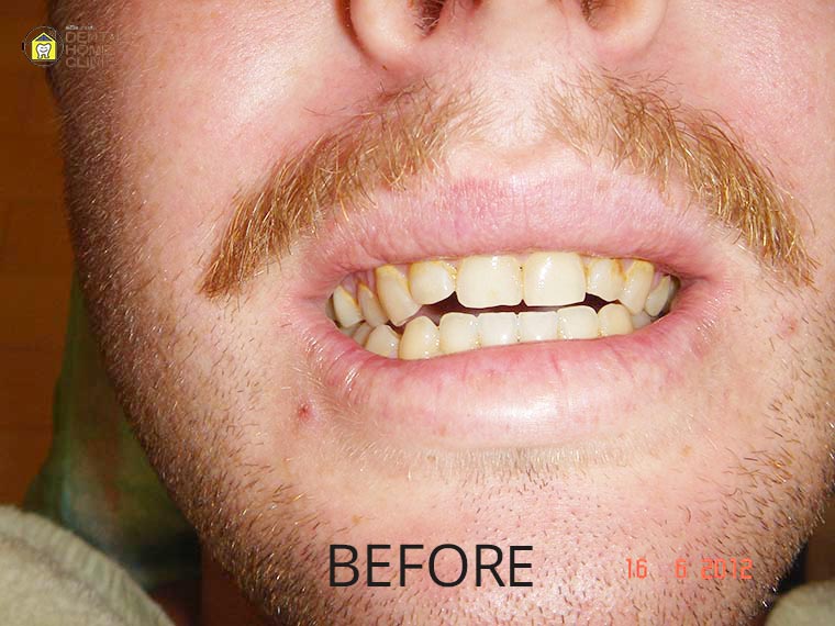 Smile Makeover