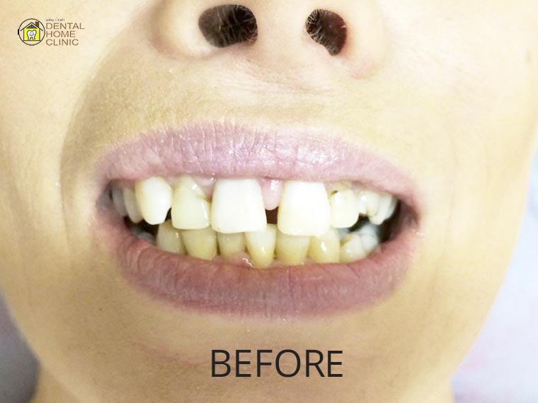 Smile Makeover