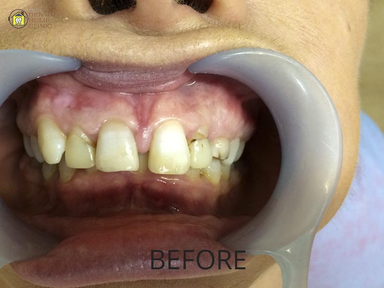 Smile Makeover